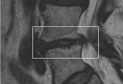 vertebrogenic-pain-modic-changes